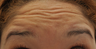 Botox to forehead and glabella