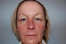 IPL Limelight Laser treatment, Pearl Laser Treatment and Botox