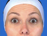 Botox Frontalis