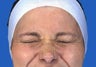 Botox Crow's Feet