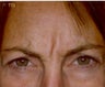 Botox