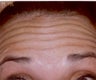 Botox