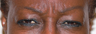 Botox for the frown lines