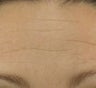 Forehead after Botox