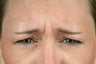 Botox