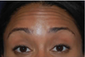 Botox to Treat Horizontal Forehead Lines