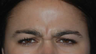 Botox to Treat Frown Lines and Vertical Lines Between Eyebrows