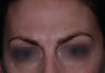 Botox