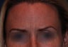 Botox