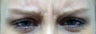 BOTOX Cosmetic