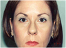 Chemical Brow Lift