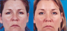 Botox