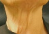 Botox Injections for Platisma Bands