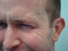 Botox- Crow's Feet