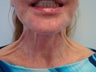 Botox