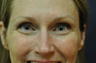 Botox