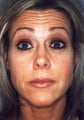 Botox