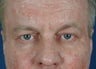 Man in 50's seek non-surgical facial rejuvention