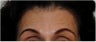 Botox