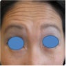 Botox
