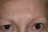 Brow asymmetry