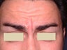 Botox