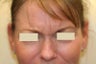 Botox