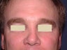 Botox