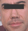 Botox between the eyes