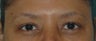 Botox Treatment