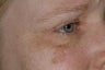 Non-surgical eye rejuvenation