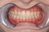 Underbite, Grummons Facemask