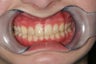 Lower Jaw Growth, Cosmetic Smile