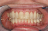 Adult Overbite, Nonextraction (braces)