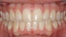 Upper Expander, Stunning Smile