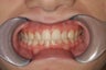 Upper Expander, Narrow Jaw, Impacted Canine