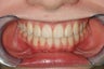 Crowding, Jaw Development