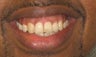 Braces: correction of openbite and dental crowding