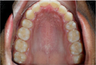 Braces and Extraction