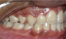 Braces and Extraction