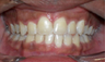 Braces and Extraction