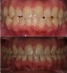 Extraction and space closure