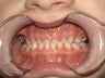 Underbite, Grummons Facemask