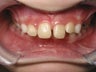 Lower Jaw Growth, Cosmetic Smile