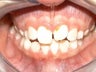 Upper Expander, Stunning Smile