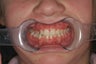 Upper Expander, Narrow Jaw, Impacted Canine