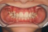 Crowding, Jaw Development