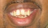 Braces: correction of openbite and dental crowding
