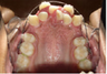 Braces and Extraction
