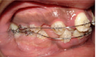 Braces and Extraction